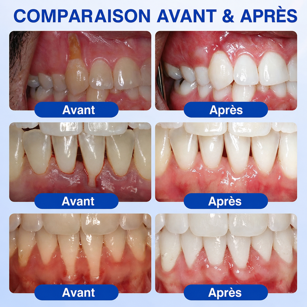 Gel Healrize® GumRevive pour la régénération des tissus parodontaux (pour les saignements et la rétraction des gencives ainsi que le déchaussement des dents)🪥🦷1